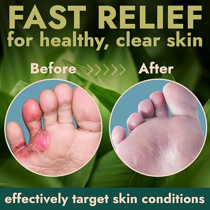 Tea Tree Oil Antifungal Foot Gel | Relieves Jock Itch, Athleteβs Foot & Ringworm | Soothes Itching & Burning | Moisturizes Dry, Cracked Feet | No-Touch Applicator | 1-Week Treatment Option | 20g