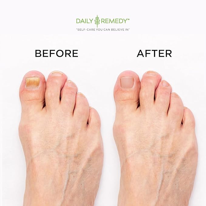 EXTRA STRENGTH Tea Tree Oil Foot Soak with Epsom Salt - Made in USA - for Toenails, Athlete's Foot, Itchy Feet, Stubborn Smelly Foot Odor, Pedicure, Foot Calluses & Soothes Sore Tired Achy Feet-2 Pack