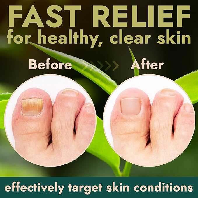 Nail Fungus Treatment Extra Strength for Toenail & Fingernails | Antifungal Nail Treatment with Tea Tree Oil | Fast-Acting, No-Touch Applicator | Restores Thickness & Discoloration | 20g